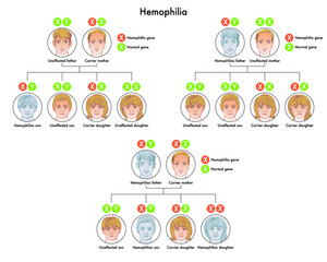 Diagram shows that healthy carrier children or with hemophilia are the consequence of a genetic alteration of the X chromosome transmitted to them by their parents.