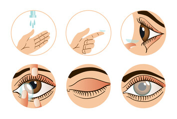Contact lens infographic. Cartoon vector illustration of 6 step to put in contact lens for web site design. Put on lenses instruction