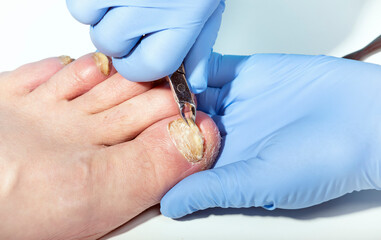 A dermatologist removes the affected nail with forceps for further treatment of a patient with damage to the nail plate on the feet