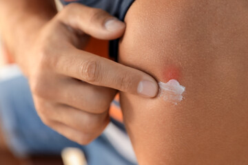 Man applying insect repellent cream on his arm outdoors, closeup