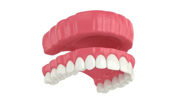 Removable traditional denture installation