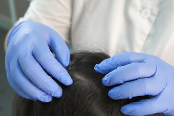Doctor trichologist in gloves is examining woman skin on head in cosmetology clinic, closeup view. Cosmetologist preparing to make treatment procedure to patient against dandruff in the hair.