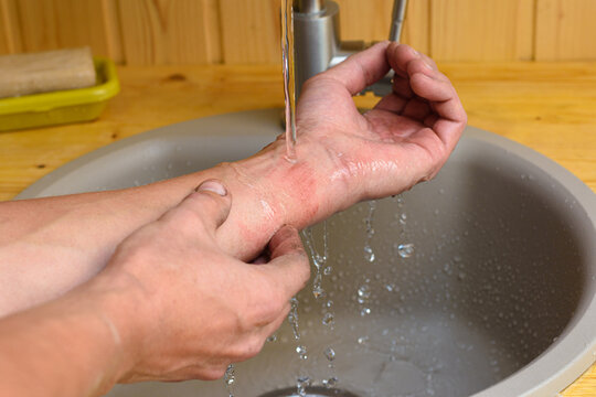A man washes the wound on his arm under running water in the sink