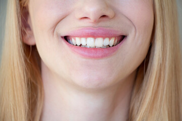 Obraz premium Teen with malocclusion and crooked teeth