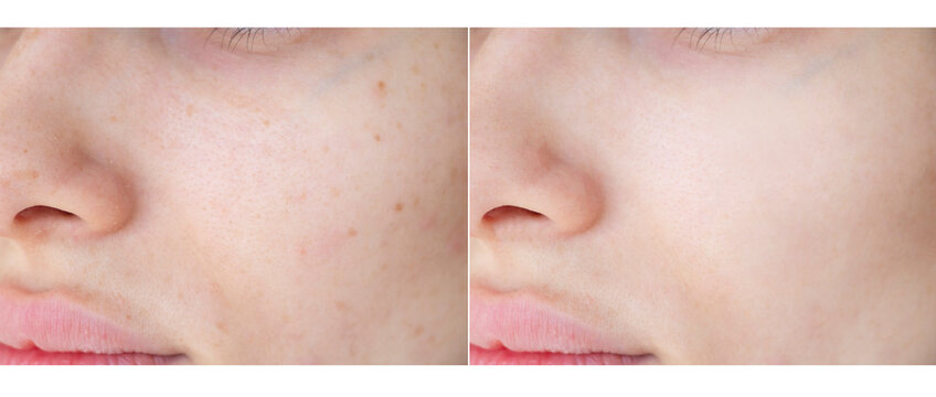 
laser removal of freckles and age spots. before and after photos