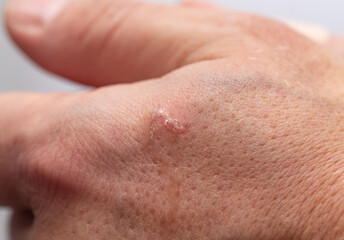 wound on the finger as a background