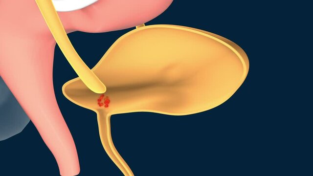 Cystitis, urinary tract infection or inflammation of the bladder. The bacteria enters the bladder via the urethra and multiplies causing the infection. 3D animation on black background