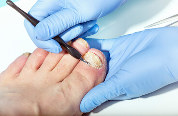 The doctor removes cuticles for further treatment of a patient with damage to the nail plate on the feet