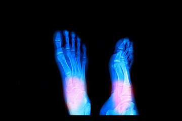 X-ray of foots bones, Represents inflammation of the muscles and wrist bones.