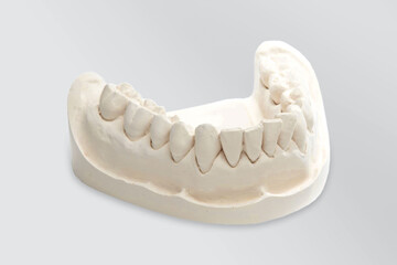 White mold dental of plaster, dental mold with a prosthesis, Dental Stone.