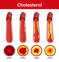 Cholesterol in artery, health risk , vector design