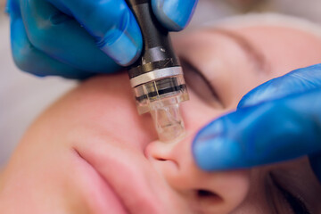 Woman cleaning nose skin pores using vacuum blackhead remover, cosmetic procedure.