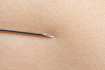 Macro photo of a medical needle with a syringe on a person's body on the skin. Injection of medication or vaccination