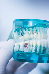 Tooth decay dental model