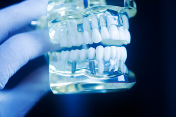 Dental tooth implant model