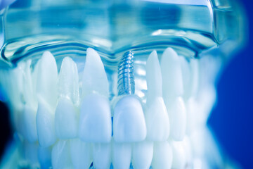 Dental tooth implant model
