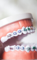 Dental teeth aligners brackets