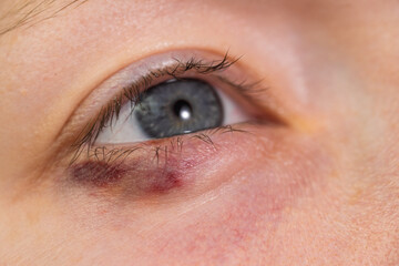 A blue eye with a slight bruise