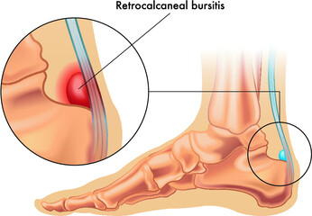 Illustration showing the position of the normal retrocalcaneal bursa in the foot, and in enlarged detail a retrocalcaneal bursitis, annotated on white.