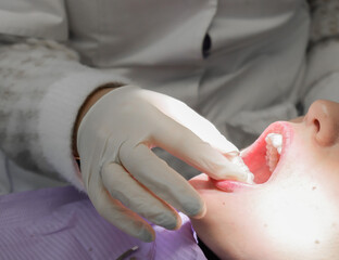 The patient at the dentist.
The dentist puts the aligner on the patient's lower jaw, close-up side view.