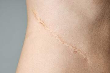 surgery scar after kidney pyelonephritis. after remove kidney operation. caucasian person close up over gray background