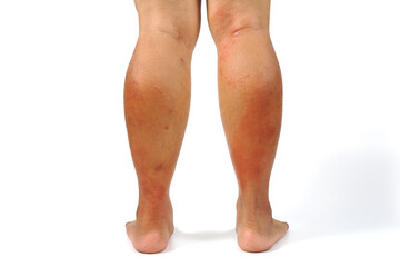 A close-up of bad psoriasis on a person's leg. Eczema allergy skin, dermatologic diseases. 