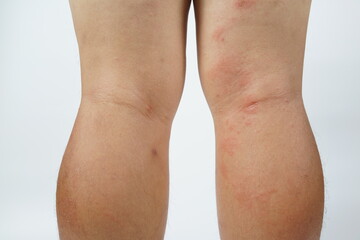 A close-up of bad psoriasis on a person's leg. Eczema allergy skin, dermatologic diseases. 
