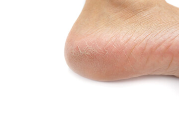 Fototapeta premium Close-up female sore skin of feet, dry heels isolated on a white background