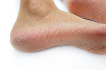 Close-up female sore skin of feet, dry heels isolated on a white background