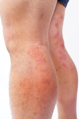 A close-up of bad psoriasis on a person's leg. Eczema allergy skin, dermatologic diseases. 