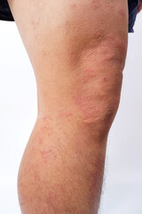 A close-up of bad psoriasis on a person's leg. Eczema allergy skin, dermatologic diseases. 