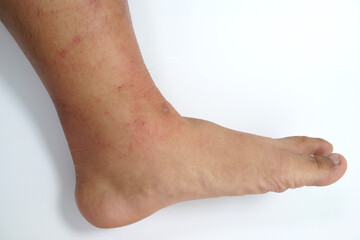 A close-up of bad psoriasis on a person's leg. Eczema allergy skin, dermatologic diseases. 