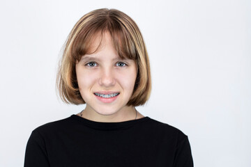 Teen girl with braces on teeth with elastic bands, focus on eyes and braces. The girl on a light background smiles, braces on teeth are visible