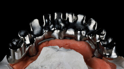 titanium dental bar on the model