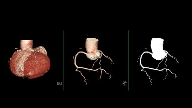 Compare CTA Coronary Artery 3D rendering  and mip image showing Coronary Artery turn around on the screen for detect heart disease .