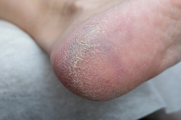 Sore heel with dry skin and cracks. Medical pedicure.