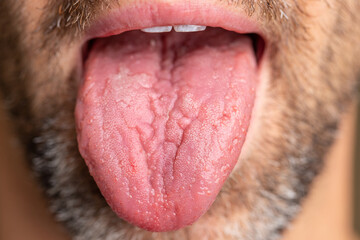 A white male with brown and white facial hair. Tongue is sticking out to show geographic tongue, also known as benign migratory glossitis where lines form and can cause pain or discomfort.