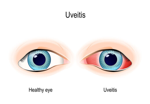 Uveitis. Inflammation Eye