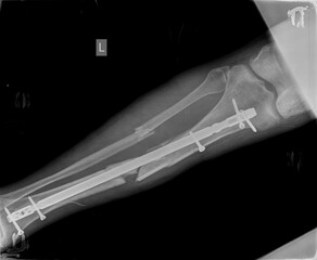 Naklejka premium Broken x ray image of leg 
