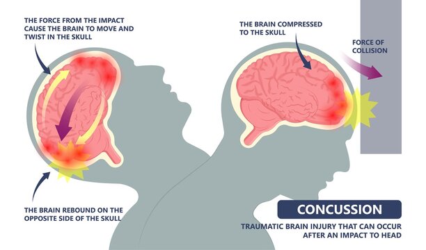 Brain Injury mild post head bleed sport loss second bump blow jolt hit skull ear contact hockey trauma fall pain athlete ball  rugby play 
