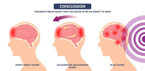 Brain Injury mild post head bleed sport loss second bump blow jolt hit skull ear contact hockey trauma fall pain athlete ball  rugby play 
