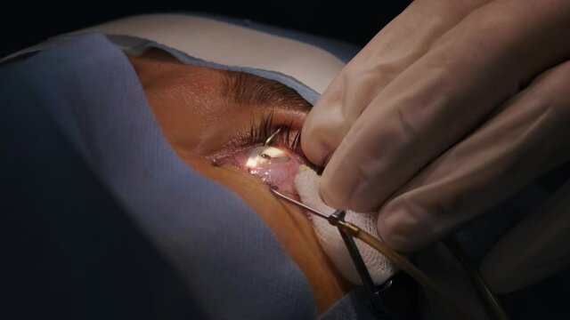 Laser vision correction. A patient and team of surgeons in the operating room during ophthalmic surgery. Eyelid speculum. Lasik treatment. Patient under sterile cover