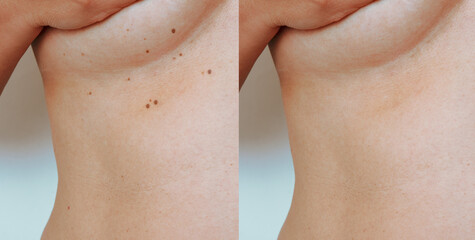 Retouched image imperfect skin.  Skin tags under female breasts. Before and after removal concept - obrazy, fototapety, plakaty