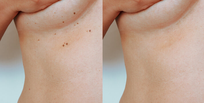 Retouched image imperfect skin.  Skin tags under female breasts. Before and after removal concept