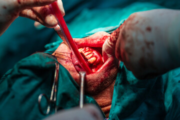 Jaw tumor removal by maxillofacial surgeons in hospital
