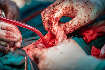 Tongue tumor removal by oral surgeons in hospital