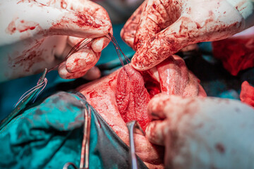 Tongue tumor removal by oral surgeons in hospital