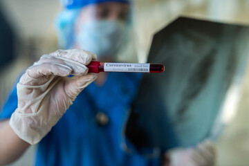 female student looks at a test tube of blood in the laboratory to determine virus coronavirus