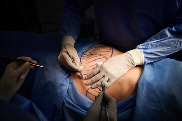 Close up of plastic surgeon hands in gloves using scalpel while doing plastic surgery in clinic. Patient with marks on belly lying on operating table. Concept of cosmetic surgery and abdominoplasty.