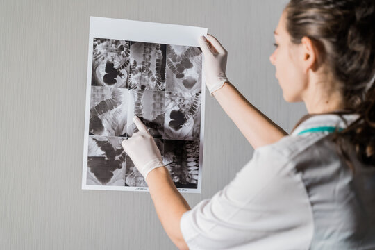 Woman doctor checking the intestine xray of dolichocolon person